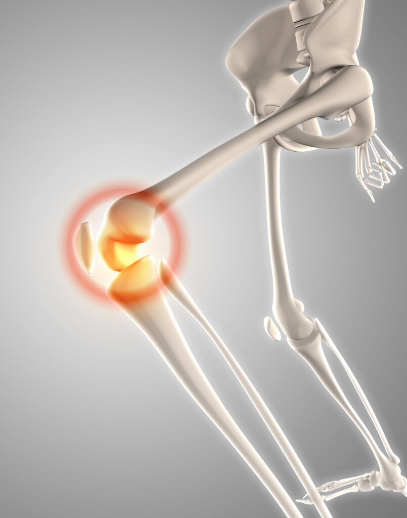 Advanced Total Knee Replacement Surgery in Dr. Srivanth's Orthopaedic Clinic hyderabad Advanced Total Knee Replacement Surgery in Hyderabad